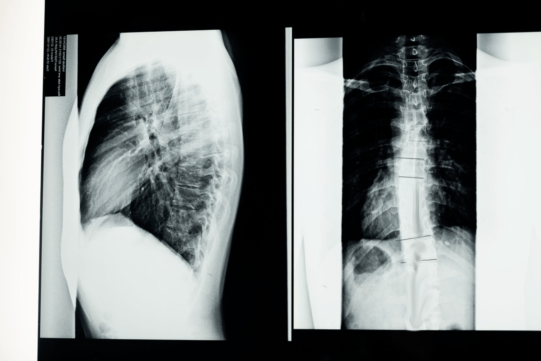a képen a nyaki gerinc osteochondrosisa