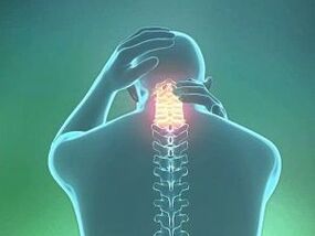 A nyaki osteochondrosis egyik tünete a fejfájás