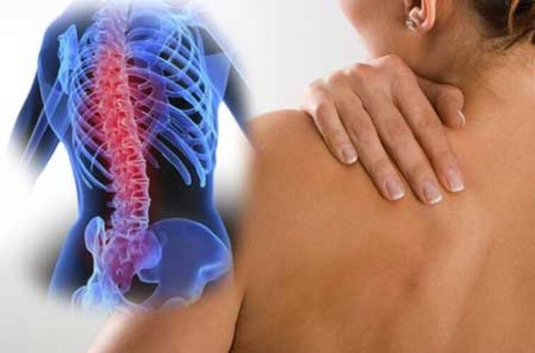Osteochondrosis esetén a fájdalom a test távoli részeire sugározhat
