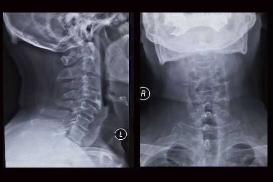 Röntgenfelvétel a nyaki gerincről (a betegnek osteochondrosisa van)