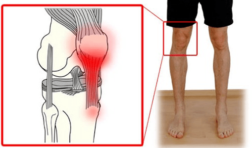 A tendinitis az ínszövet gyulladása, amely fájdalmat okoz a térdízületben. 