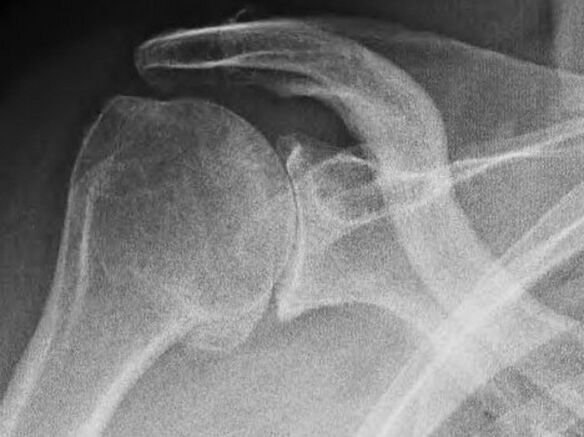 Röntgenfelvétel az arthrosis által érintett vállízületről