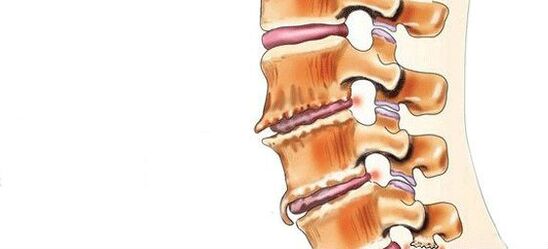 Spondylosis - Az intervertebrális ízületek megsemmisítése