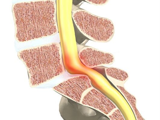 Vérmotor szegmens osteochondrosishoz