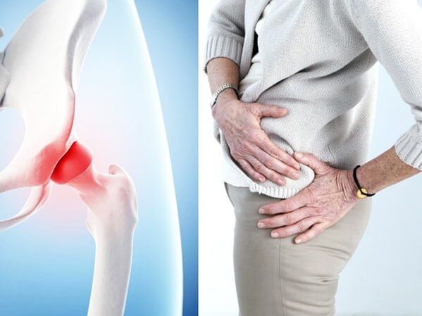 A csípőízület arthrosis tünetei