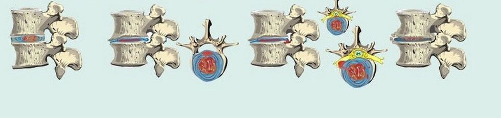 A mellkasi osteochondrosis különféle szakaszai