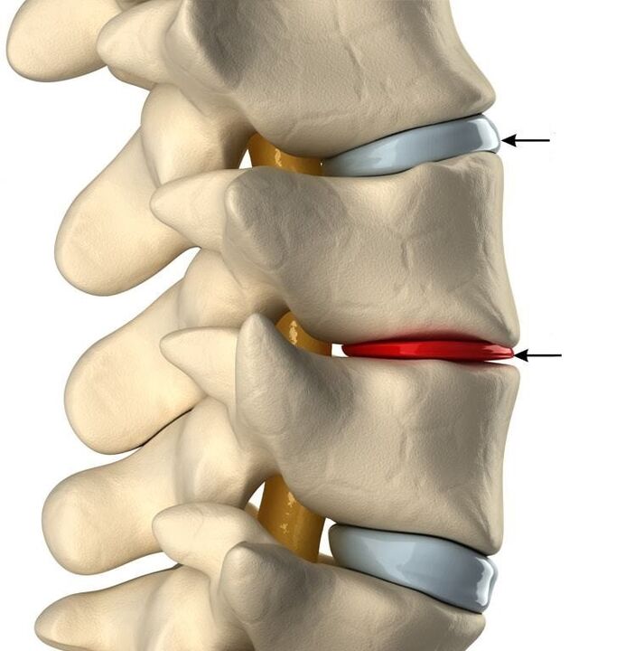 különbség az egészséges és az osteochondrosissal rendelkező lemez között