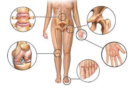 az arthrosis különböző ízületeket érint