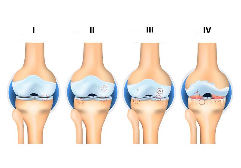 az ízületi arthrosis szakaszai