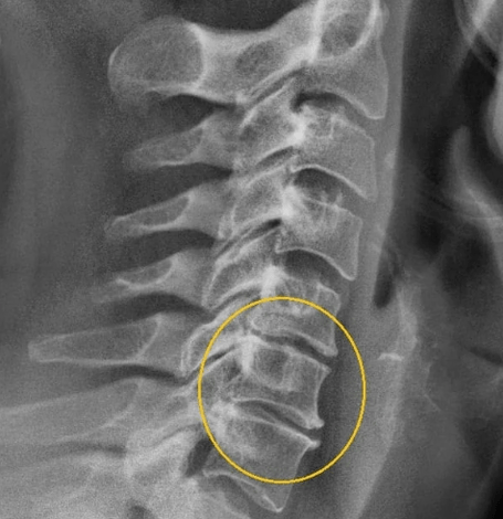 nyaki osteochondrosis