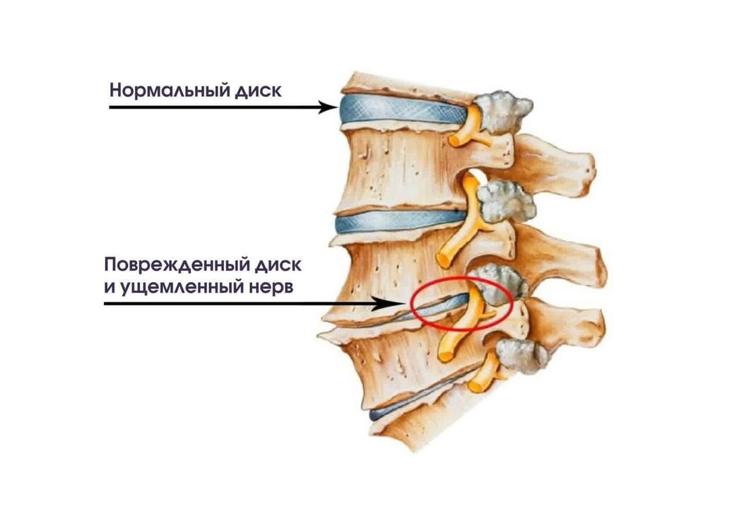 A nyaki osteochondrosis tünetei