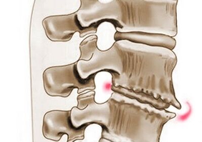 a csigolyák károsodása mellkasi osteochondrosisban