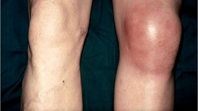 arthrosis és ízületi gyulladás