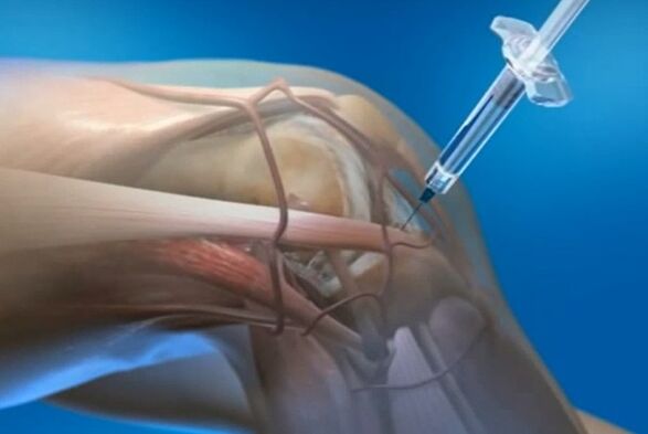 intraartikuláris injekciók a térdízület arthrosisához
